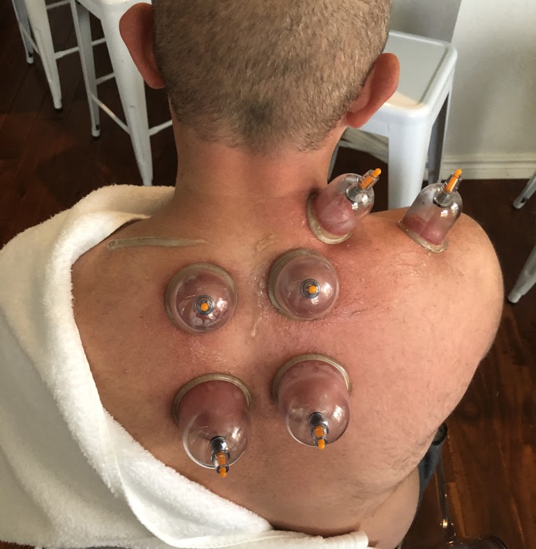 Cupping treatment for the upper back and shoulder